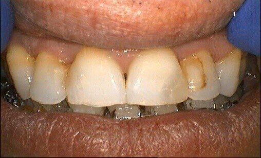 Braces - Synergy Dental Braces - Synergy Dental