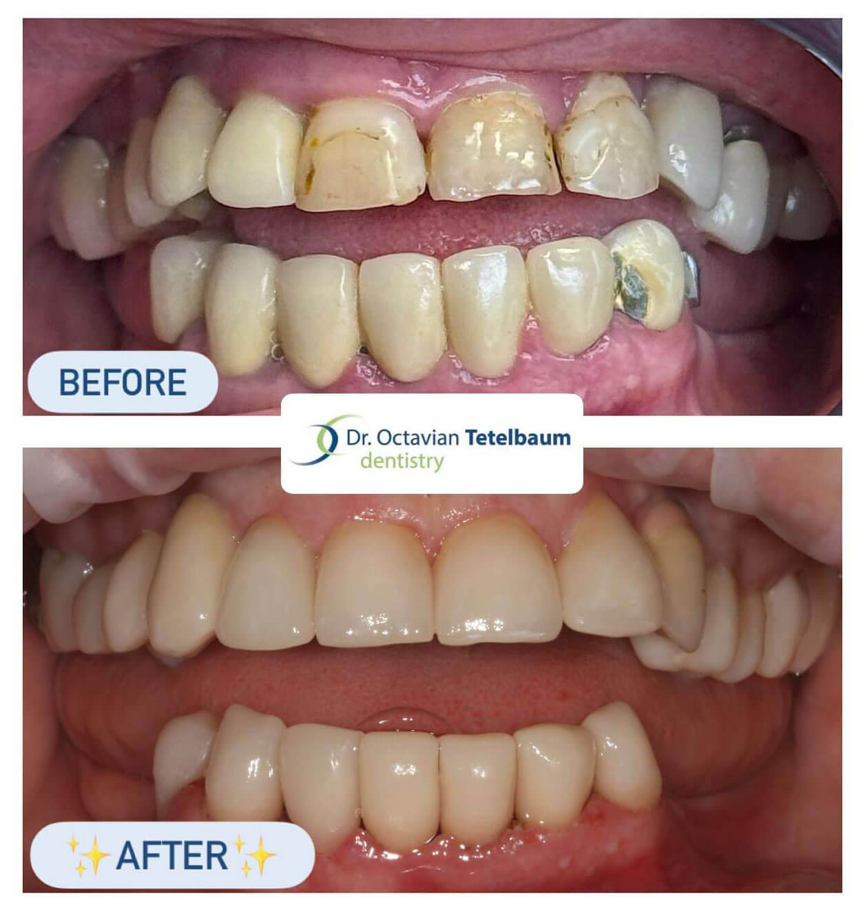 Before and after root canals, ceramic crowns, and planned dental implants