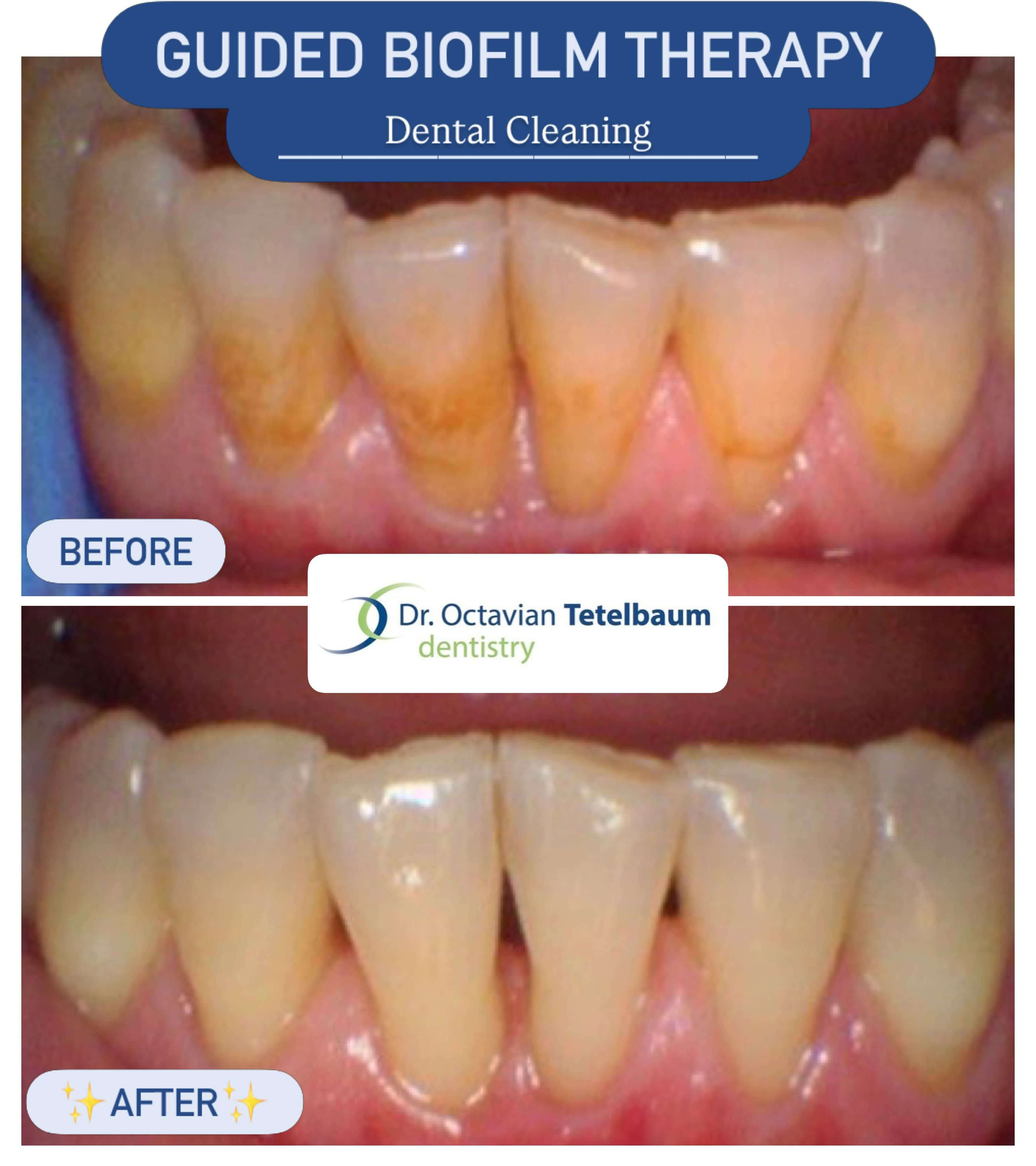 Before and after guided biofilm therapy