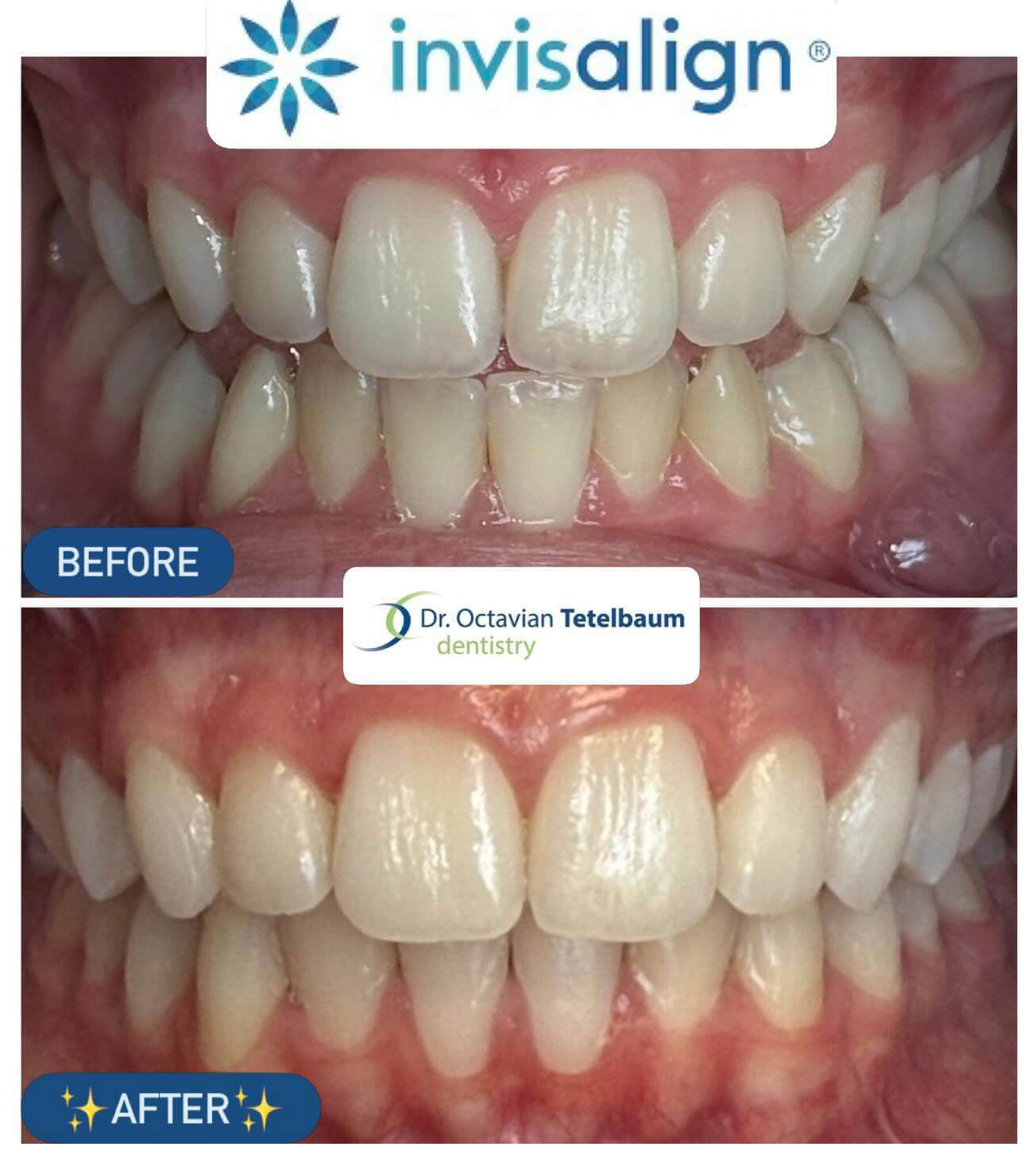 Before and after Invisalign orthodontic treatment in London Ontario