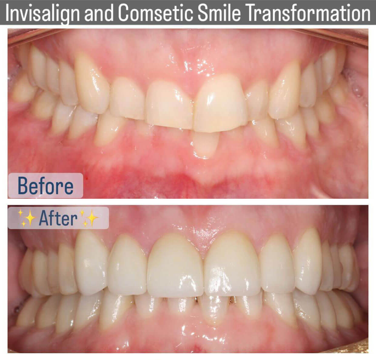 Before and after Invisalign cosmetic smile makeover and veneers