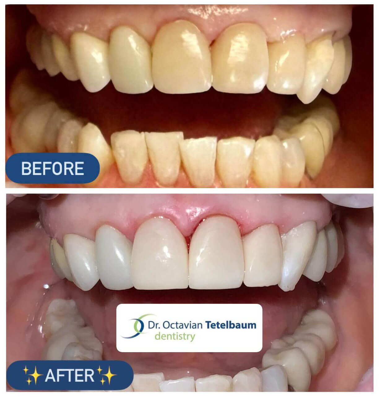 Before and after natural ceramic crowns for fragile teeth