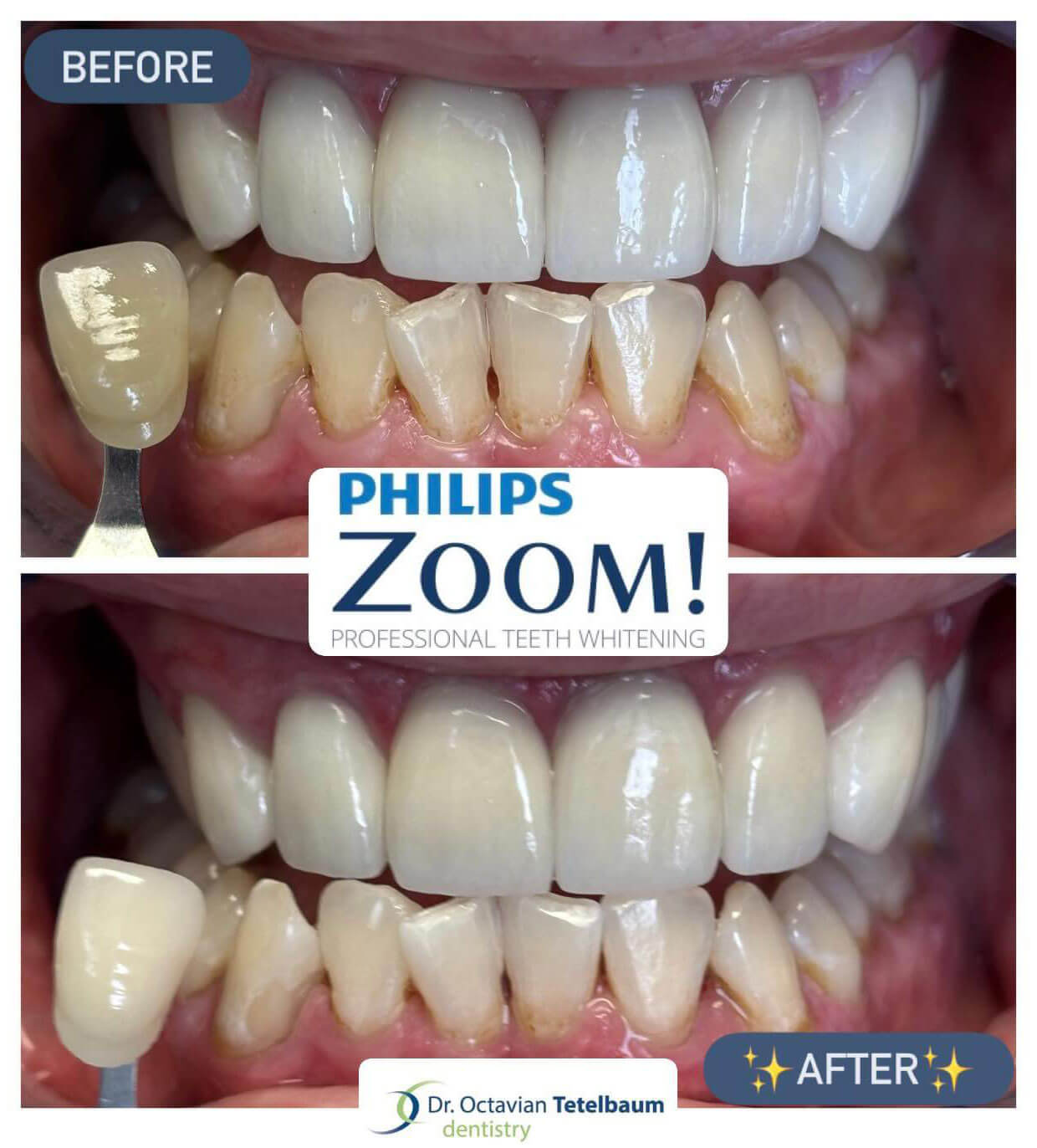 Before and after professional teeth whitening philips zoom lower teeth matching upper crowns