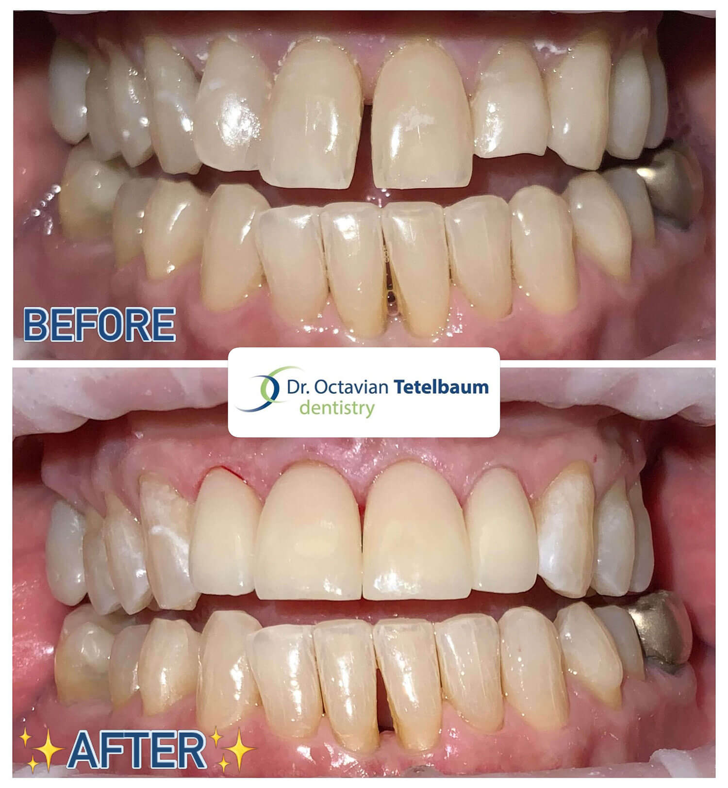 Before and after ceramic crowns and veneers restorative dentistry
