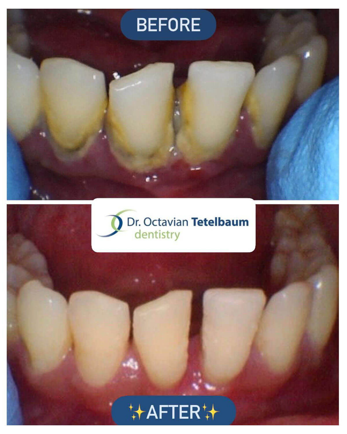 Before and after extensive plaque and tartar buildup removal